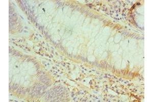 Immunohistochemistry of paraffin-embedded human colon cancer using ABIN7147161 at dilution of 1:100 (CD48 antibody  (AA 27-125))