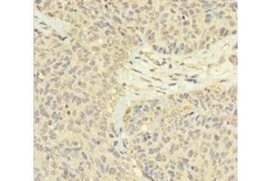 Immunohistochemistry of paraffin-embedded human ovarian cancer using ABIN7165526 at dilution of 1:100 (FAM60A antibody  (AA 1-221))