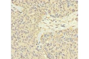 Immunohistochemistry of paraffin-embedded human ovarian cancer using ABIN7165526 at dilution of 1:100 (Protein FAM60A (SINHCAF) (AA 1-221) antibody)