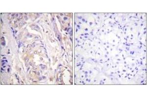 Immunohistochemistry analysis of paraffin-embedded human breast carcinoma tissue, using MEK1 (Ab-286) Antibody.