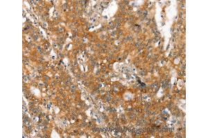 Immunohistochemistry of Human gastic cancer using MMP2 Polyclonal Antibody at dilution of 1:60 (MMP2 antibody)
