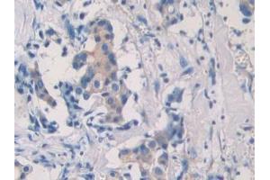 Detection of SEPT5 in Human Breast cancer Tissue using Polyclonal Antibody to Septin 5 (SEPT5)