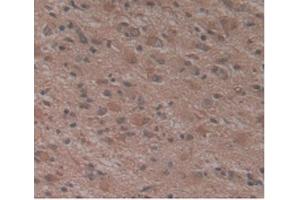 Detection of ATN1 in Human Glioma Tissue using Monoclonal Antibody to Atrophin 1 (ATN1) (Atrophin 1 antibody  (AA 879-1190))