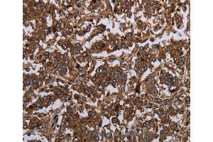 Immunohistochemistry of Human gastric cancer using HOMER2 Polyclonal Antibody at dilution of 1:30