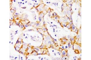 IHC-P: beta Catenin antibody testing of human breast cancer tissue (beta Catenin antibody  (AA 764-781))