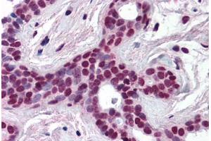 Human Breast (formalin-fixed, paraffin-embedded) stained with CUL3 antibody ABIN218508 at 1:500 followed by biotinylated goat anti-rabbit IgG secondary antibody ABIN481713, alkaline phosphatase-streptavidin and chromogen. (Cullin 3 antibody  (N-Term))