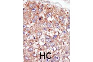 Formalin-fixed and paraffin-embedded human hepatocellular carcinoma tissue reacted with PTK6 polyclonal antibody  , which was peroxidase-conjugated to the secondary antibody, followed by AEC staining. (PTK6 antibody  (N-Term))