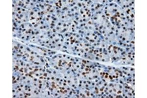 Immunohistochemical staining of paraffin-embedded Adenocarcinoma of colon tissue using anti-RC204952 mouse monoclonal antibody. (XRCC1 antibody)