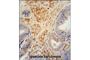 FSTL1 antibody immunohistochemistry analysis in formalin fixed and paraffin embedded human prostate carcinoma followed by peroxidase conjugation of the secondary antibody and DAB staining. (FSTL1 antibody  (C-Term))