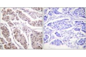 Immunohistochemistry analysis of paraffin-embedded human breast carcinoma tissue, using Histone H4 (Ab-5) Antibody. (Histone H4 antibody  (AA 1-50))