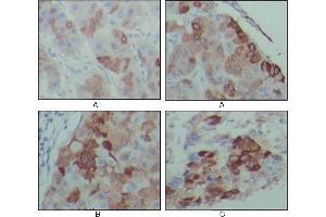 Immunohistochemical analysis of paraffin-embedded human hepatocarcinoma (A), breast carcinoma (B) and lung cancer tissues (C), showing cytoplasmic localization with DAB staining using PEG10 mouse mAb. (PEG10 antibody)