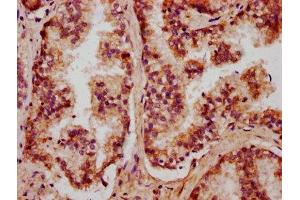IHC image of ABIN7149635 diluted at 1:400 and staining in paraffin-embedded human prostate cancer performed on a Leica BondTM system. (CXORF36 antibody  (AA 311-405))