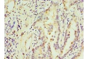 Immunohistochemistry of paraffin-embedded human lung cancer using ABIN7171228 at dilution of 1:100 (Syntaxin 16 antibody  (AA 1-300))