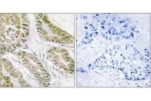 Immunohistochemistry analysis of paraffin-embedded human lung carcinoma tissue, using BAX Antibody.