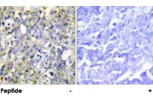 Immunohistochemical analysis of paraffin-embedded human lung carcinoma tissue using IGFBP3 polyclonal antibody . (IGFBP3 antibody  (Ser183))