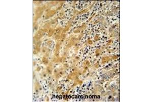 NUS antibody (N-term) 11000a immunohistochemistry analysis in formalin fixed and paraffin embedded human hepatocarcinoma followed by peroxidase conjugation of the secondary antibody and DAB staining. (NUSAP1 antibody  (N-Term))