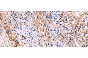 Immunohistochemistry of paraffin-embedded Human cervical cancer tissue using GALK2 Polyclonal Antibody at dilution of 1:95(x200) (GALK2 antibody)