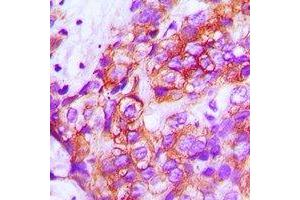 Immunohistochemical analysis of ZP1 staining in human breast cancer formalin fixed paraffin embedded tissue section. (ZP1 antibody)