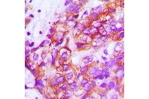 Immunohistochemical analysis of ZP1 staining in human breast cancer formalin fixed paraffin embedded tissue section.