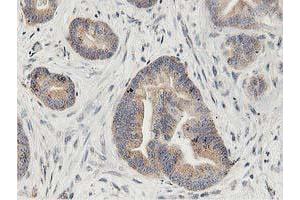 Immunohistochemical staining of paraffin-embedded Adenocarcinoma of Human colon tissue using anti-LGR5 mouse monoclonal antibody.