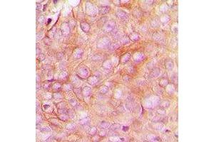 Immunohistochemical analysis of STMN1 (pS16) staining in human breast cancer formalin fixed paraffin embedded tissue section.