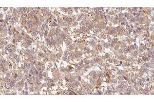 ABIN6279695 at 1/100 staining Human Melanoma tissue by IHC-P. (S100A7 antibody  (C-Term))