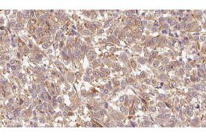 ABIN6279695 at 1/100 staining Human Melanoma tissue by IHC-P.
