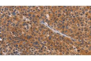 Immunohistochemistry of paraffin-embedded Human liver cancer tissue using NCR1 Polyclonal Antibody at dilution 1:30 (NCR1 antibody)
