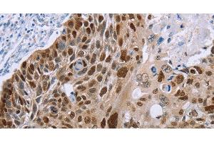 Immunohistochemistry of paraffin-embedded Human esophagus cancer using MAGEA10 Polyclonal Antibody at dilution of 1:50 (MAGEA10 antibody)