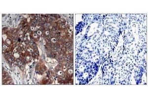 Immunohistochemical analysis of paraffin- embedded human breast carcinoma tissue using HER2 (Ab-877) antibody (E021070). (ErbB2/Her2 antibody)