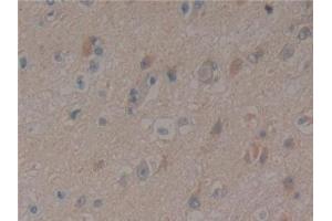 Detection of PXN in Human Glioma Tissue using Polyclonal Antibody to Paxillin (PXN) (Paxillin antibody  (AA 201-461))