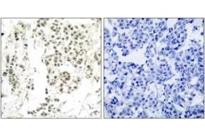 Immunohistochemistry analysis of paraffin-embedded human breast carcinoma, using Chk1 (Phospho-Ser345) Antibody. (CHEK1 antibody  (pSer345))