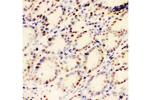 IHC analysis of EWSR1 using anti-EWSR1 antibody (ABIN3043825). (EWSR1 antibody  (Middle Region))
