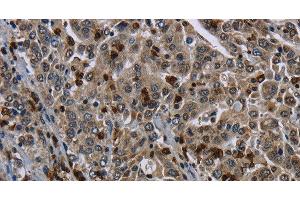Immunohistochemistry of paraffin-embedded Human liver cancer tissue using CD42b Polyclonal Antibody at dilution 1:50 (CD42b antibody)