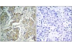 Immunohistochemistry analysis of paraffin-embedded human breast carcinoma, using VEGFR2 (Phospho-Tyr1214) Antibody.