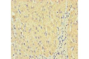 Immunohistochemistry of paraffin-embedded human liver cancer using ABIN7158295 at dilution of 1:100 (LAIR2 antibody  (AA 22-152))