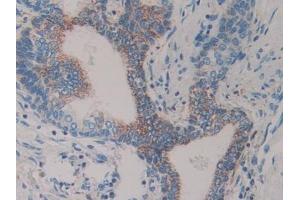 Detection of Slit1 in Human Prostate Tissue using Polyclonal Antibody to Slit Homolog 1 (Slit1) (SLIT1 antibody  (AA 603-773))