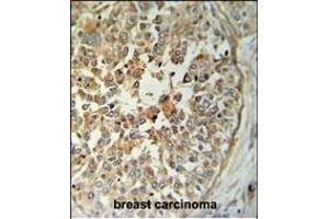 T Antibody (C-term) (ABIN653764 and ABIN2843060) IHC analysis in formalin fixed and paraffin embedded breast carcinoma followed by peroxidase conjugation of the secondary antibody and DAB staining. (STING/TMEM173 antibody  (C-Term))