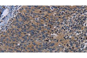 Immunohistochemistry of paraffin-embedded Human cervical cancer tissue using PCDHB15 Polyclonal Antibody at dilution 1:50 (PCDHB15 antibody)