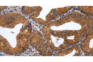 Immunohistochemistry of paraffin-embedded Human cervical cancer tissue using GATA6 Polyclonal Antibody at dilution 1:35 (GATA6 antibody)