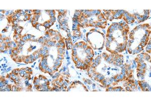 Immunohistochemistry of paraffin-embedded Human thyroid cancer tissue using ALDH5A1 Polyclonal Antibody at dilution 1:60