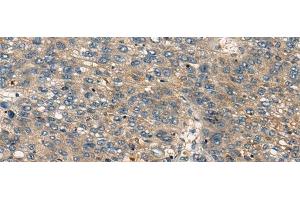 Immunohistochemistry of paraffin-embedded Human liver cancer tissue using CDKL2 Polyclonal Antibody at dilution of 1:25(x200) (CDKL2 antibody)