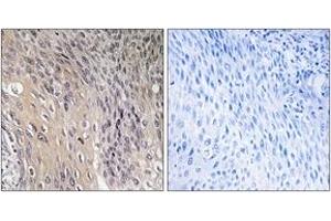 Immunohistochemistry analysis of paraffin-embedded human cervix carcinoma, using ARHGDIA (Phospho-Ser174) Antibody. (ARHGDIA antibody  (pSer174))