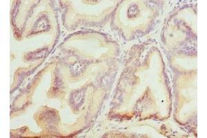 Immunohistochemistry of paraffin-embedded human prostate cancer using ABIN7145599 at dilution of 1:100 (Biliverdin Reductase antibody  (AA 1-296))