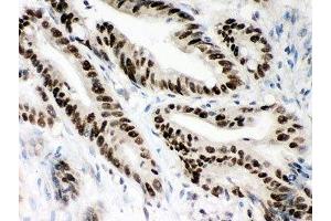 IHC-P: MSH2 antibody testing of human intestine cancer tissue (MSH2 antibody  (AA 337-583))
