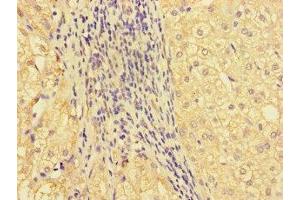 Immunohistochemistry of paraffin-embedded human liver cancer using ABIN7161686 at dilution of 1:100 (GBA2 antibody  (AA 656-867))