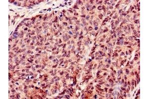 Immunohistochemistry of paraffin-embedded human ovarian cancer using ABIN7155434 at dilution of 1:100 (Histone H3.3 antibody  (AA 2-136))