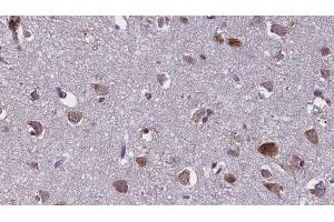 ABIN6274927 at 1/100 staining Human brain cancer tissue by IHC-P. (BCAS4 antibody)