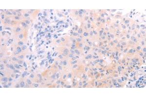 Immunohistochemistry of paraffin-embedded Human lung cancer tissue using AMH Polyclonal Antibody at dilution 1:30 (AMH antibody)