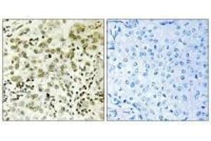 Immunohistochemistry analysis of paraffin-embedded human breast carcinoma tissue, using CTDSP1 antibody. (CTDSP1 antibody  (N-Term))